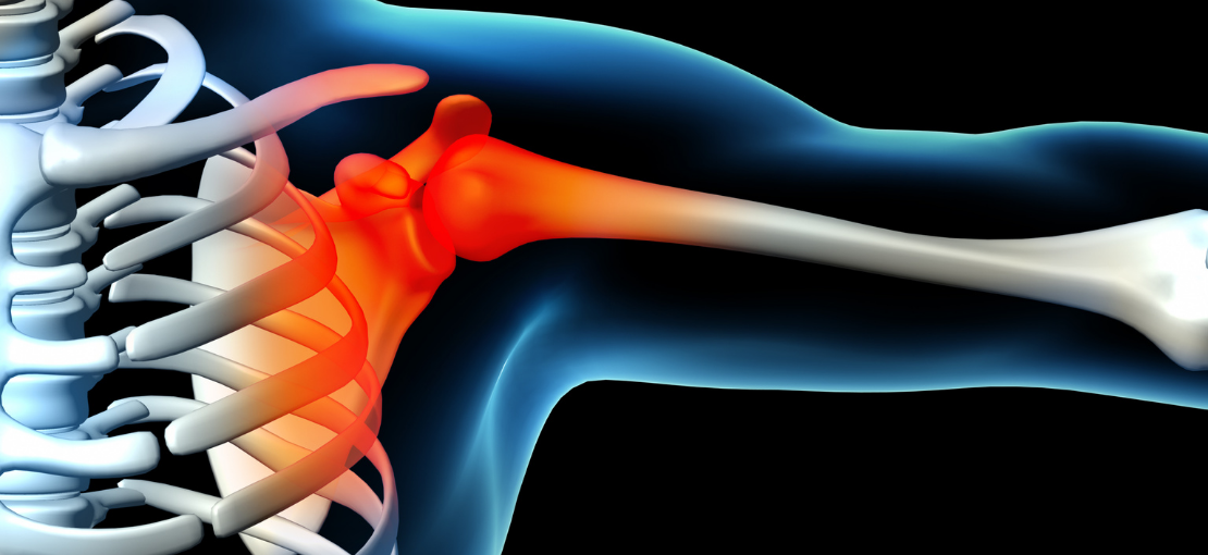 tens terapia per trattamento della tendinite alla spalla (2)