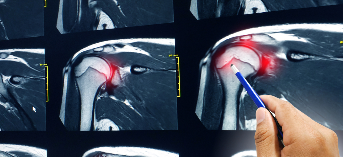 trattamento infiammazione cuffia dei rotatori con laseterapia